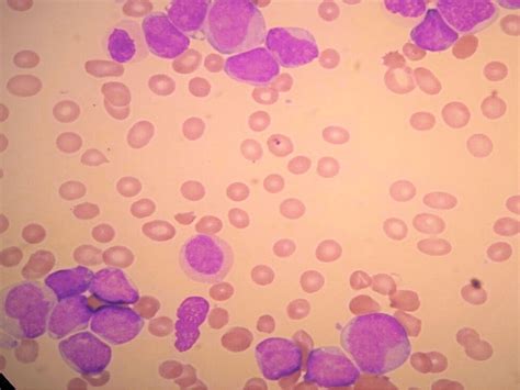 Blood Film Showing Markedly Elevated Monoblasts And Promonocytes