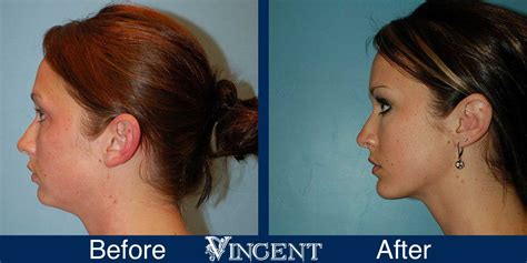 Vincent Surgical Arts Kybella Injections In Cottonwood Heights Ut