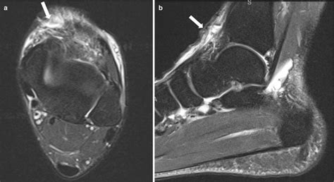 Fig 81 Anterior Tibialis Tendon Tear Axial Musculoskeletal