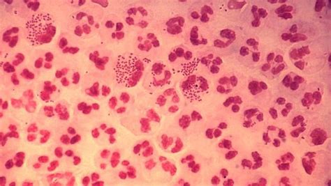 Antibiotic Resistant Gonorrhea Is On The Rise Who Says