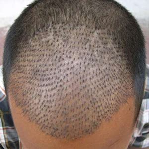 What is the recovery process post hair transplant in india? Hair Transplant Cost in Vietnam, Low Cost Hair Transplant ...