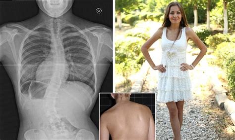 Teenager Overcomes Spine Condition Scoliosis To Become Model Daily Mail Online