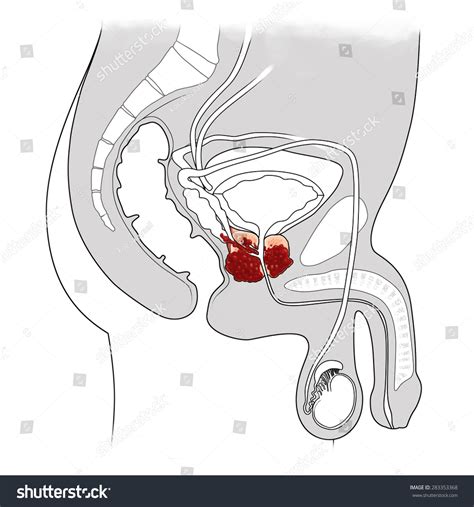 Cancer Prostate Anatomy Cross Section Illustration Stock Illustration Shutterstock