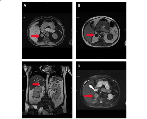 Magnetic Resonance Imaging Of The Adrenal Gland A T1 Weighted In Phase