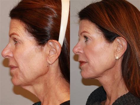 Neck Lift Submentoplasty Before And After Pictures Case Atlanta