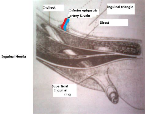Mbbs Medicine Humanity First Difference Between Inguinal Hernias