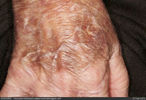 Stock Image Dermatology Senile Purpura A Brown Discolouration From