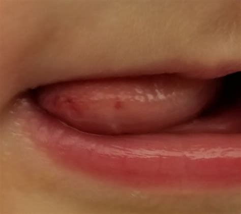 Red Bumps On Tip Of Tongue Babycenter