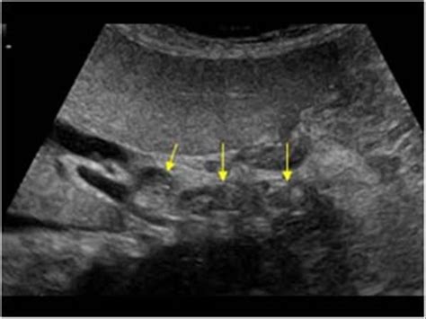 Wk 4 Biliary Tree Pathology Multiple Common Bile Duct Stones