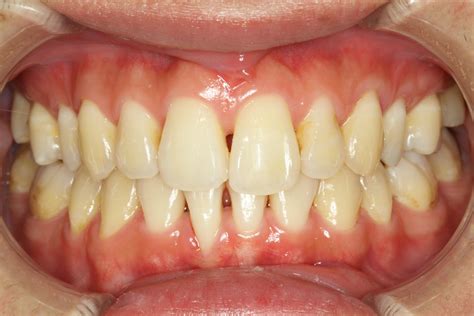矯正後に歯と歯の間の歯茎が下がってしまったケース 歯茎の再生で歯周病から歯を守る