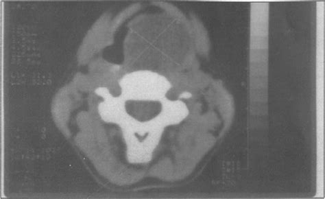 Ct Scan Showing The Laryngeal Cyst In Children Than In Adults The