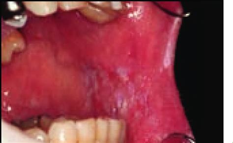 Candidal Leukoplakia Typically Affecting The Mucosa In The Commissure