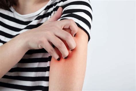 12 Common Skin Irritations Their Causes Treatment And Prevention