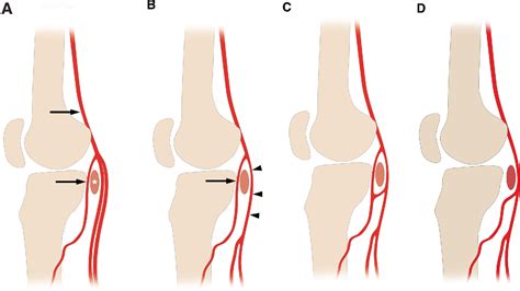 Branches Of Anterior Tibial Artery The Aberrant Anterior Tibial My
