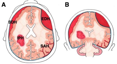 Subdural Hematoma Vs Subarachnoid Hemorrhage