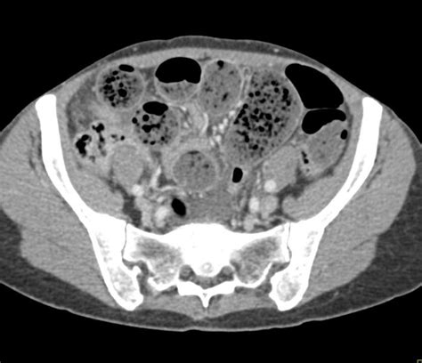 Small Bowel Obstruction With The Feces Sign Small Bowel Case Studies