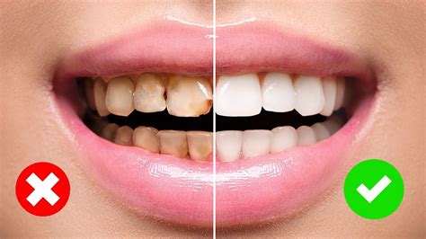 He believes that you can prevent and heal cavities with nutrition. 4 Simple Ways to Naturally Reverse Cavities and Heal Tooth ...
