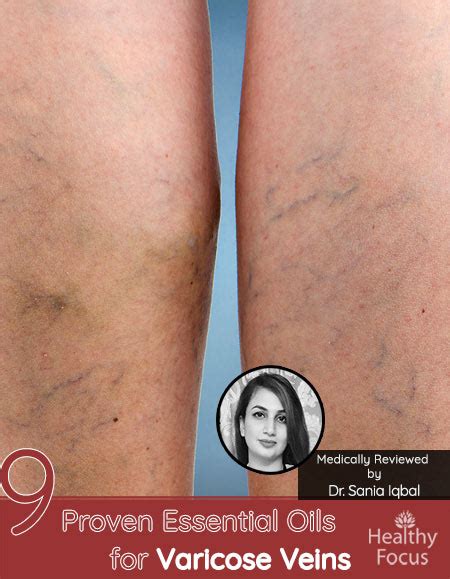 9 Proven Essential Oils For Varicose Veins Healthy Focus