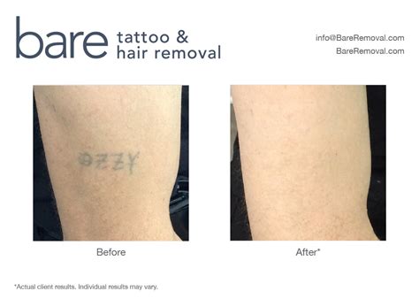 Greater Chicago Laser Tattoo Removal · Bareremoval