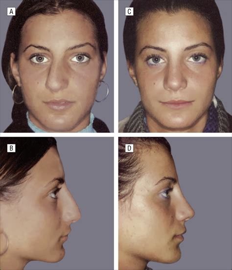 Fan Septoplasty For Correction Of The Internally And Externally