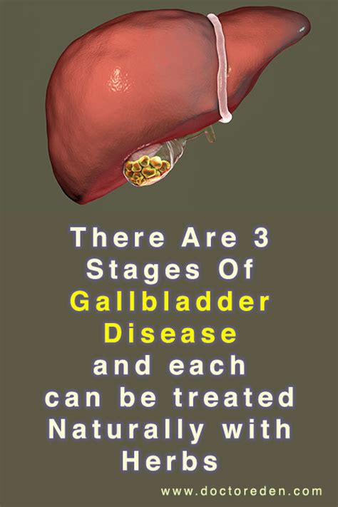 Stages Of Gallbladder Disease And How To Avoid It Remove Gallstones Without Surgery