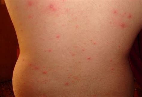 Maculopapular Rash Pictures Causes Treatment Definition Signs