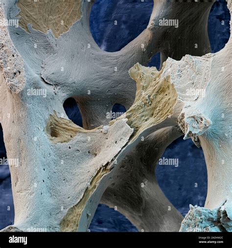 Osteoporotic Bone Coloured Scanning Electron Micrograph Sem