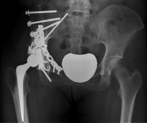 B A Pre Operative Anteroposterior Ap Pelvic Radiograph Of A