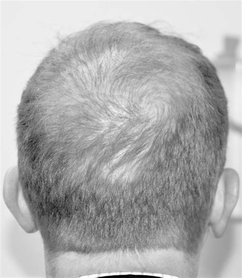 Top 188 Crown Hair Transplant Success Rate Polarrunningexpeditions