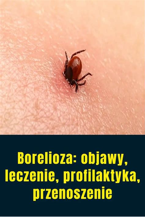 Borelioza Objawy Leczenie Profilaktyka Przenoszenie