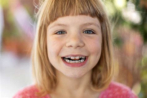 Benefits Of Braces For Kids Pediatric Dentistry Services Tx