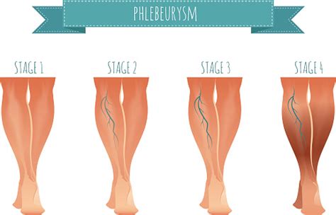 Phlebology Infographic Treating Varicose Veins Vector Illustration Of