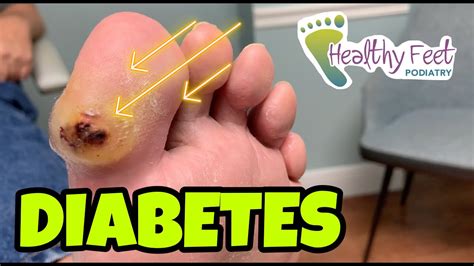 Diabetic Blister How To Treat Diabetic Ulcers Youtube