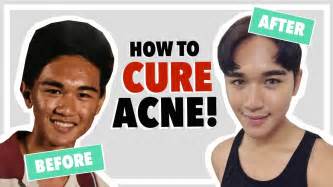 How To Cure Severe Acne Product Review Primped And Primed Youtube