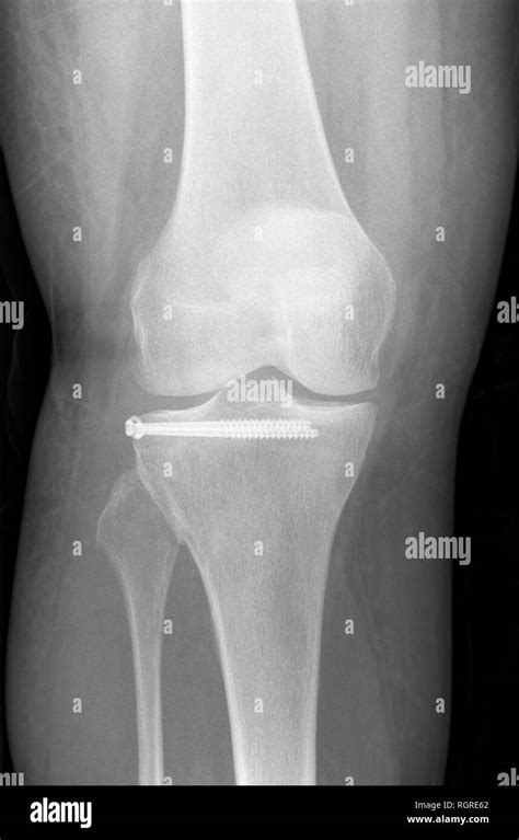 X Ray Image Of Patient After Tibial Plateau Fracture With 2 Screws
