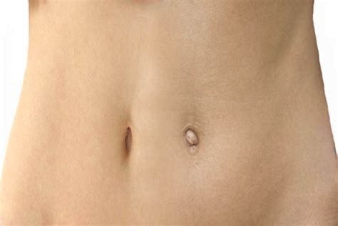 Why Do Some People Have Protruding Navel While Some Have Bowl Shaped Navel