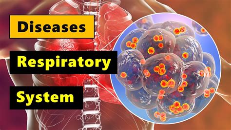 Diseases Of The Respiratory System I Grade 9 Q1 L Part 1 Youtube