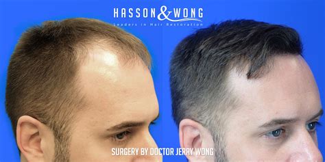 A different hair transplantation method, follicular unit extraction (fue), was first developed as a technique in the 1990s by australian physician dr ray wood and his sister dr angela campbell 6. Hair Transplant Before And After | FUE Hair Transplant ...