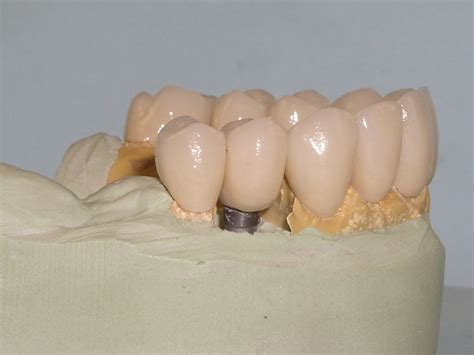 Dental Case Study 11 North Shore Restorative And Implant Dentistry