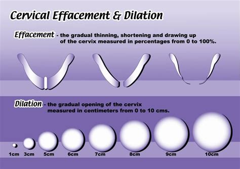 Pic Diagram Of Dilation And Cervical Effecement Dilations Dilation And Effacement Cervix