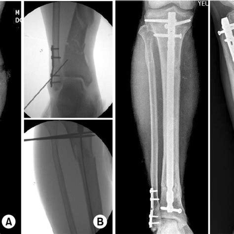 Pdf Clinical Outcomes Of The Tibia Segmental Fractures Treated By