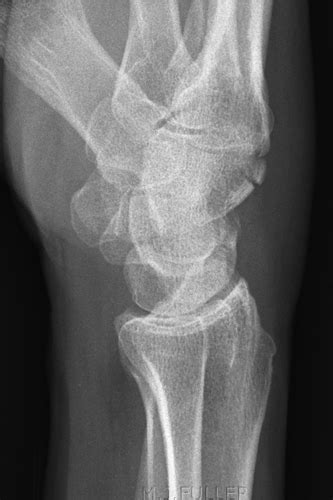 Imaging Hamate Fractures Wikiradiography