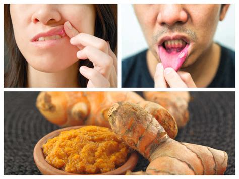 Some common factors known to trigger their growth are: What are mouth ulcers? How turmeric helps in treating ...
