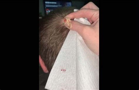 Popping Husbands Pilar Cyst On Scalp At Home Rpimplepoppersdelight
