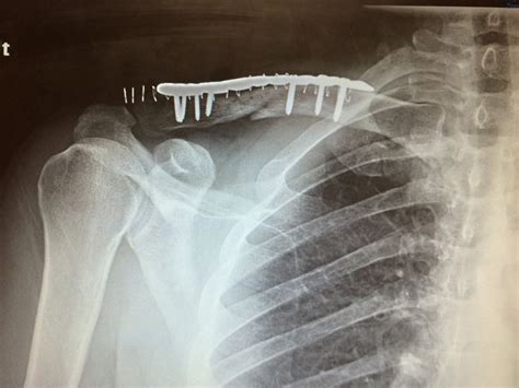 What To Do After Collar Bone Surgery Rehab