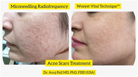 Acne Scars Treatment With Microneedling Radiofrequency Subcision Wosyet Vital Technique