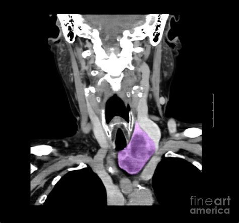 Ct Of Neck Showing Thyroid Goiter Photograph By Medical Body Scans