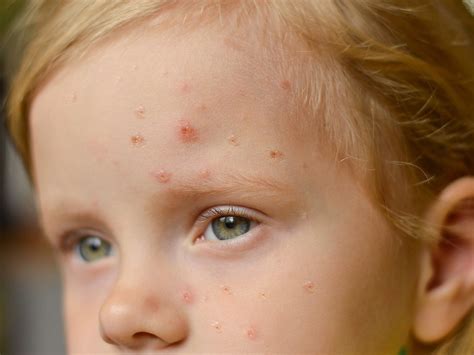 Scarlet Fever Symptoms To Look Out For And How To Treat