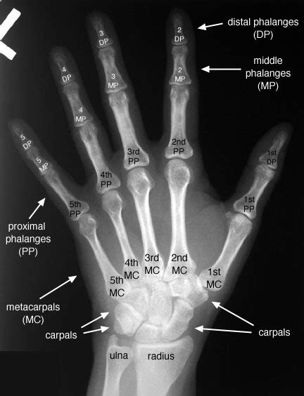 Normal Hand X Ray Hand X Ray Causes Symptoms Treatment Hand X Ray