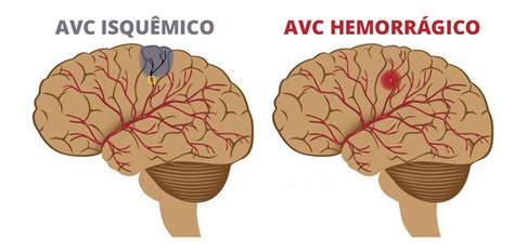 O que é o Acidente Vascular Cerebral AVC Medcor Serviços